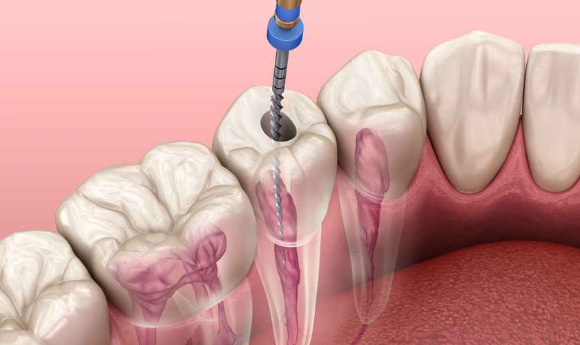 Signs Of Root Canal Problems - Kentwood Premier Dentistry