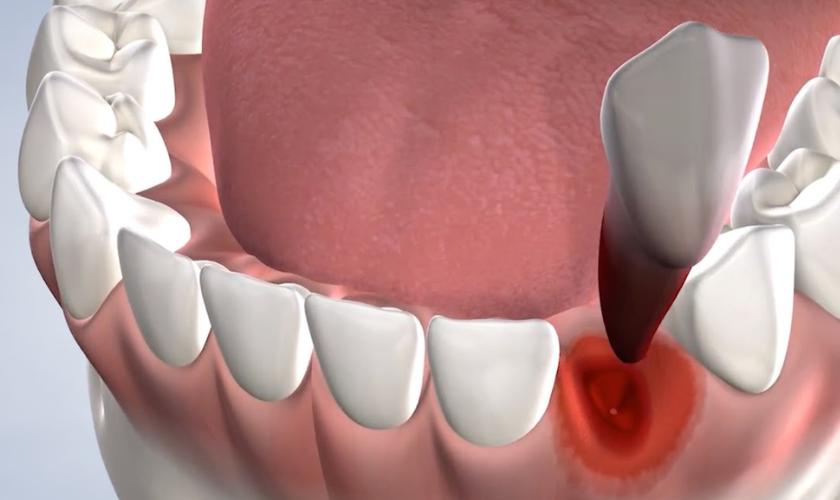 Bleeding Gum After A Tooth Extraction