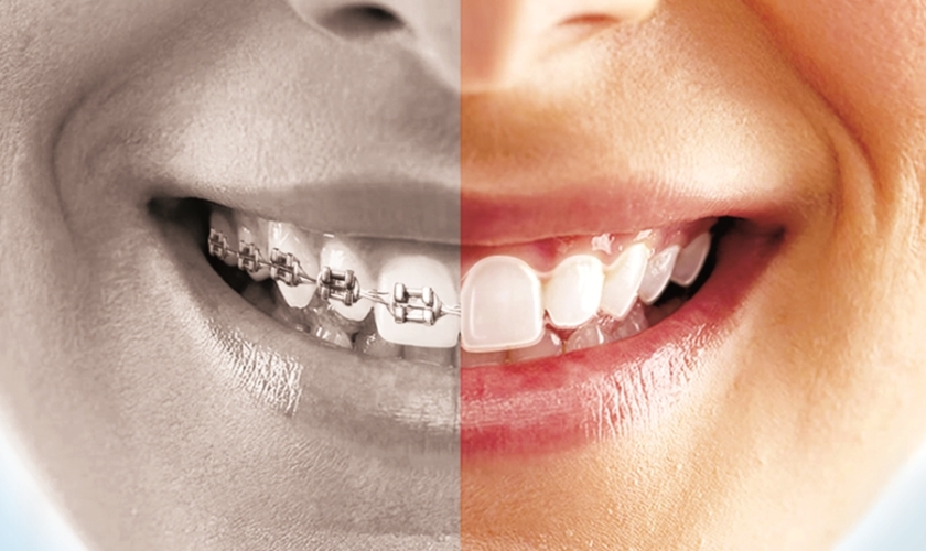 Clear Aligners vs. Braces