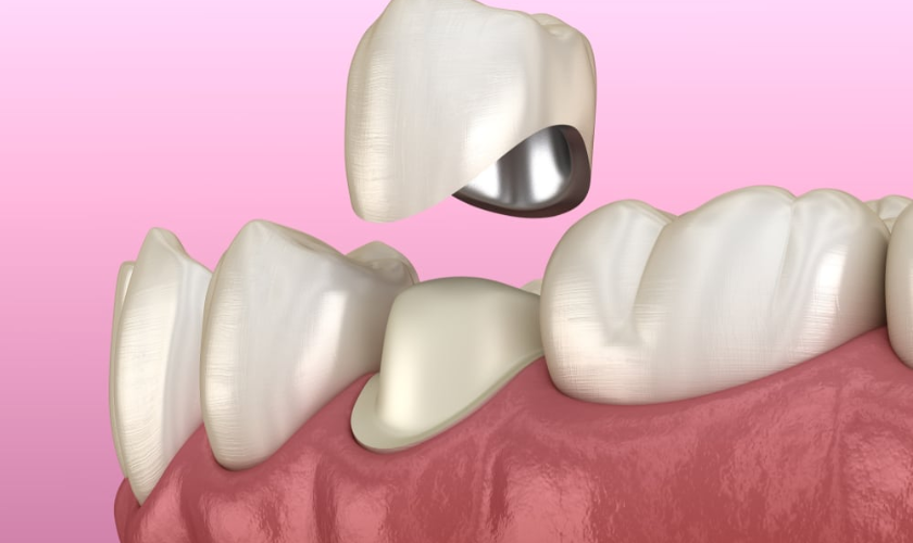 Dental Crowns