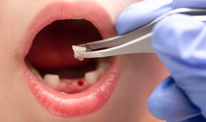 Tooth Extraction in Kentwood