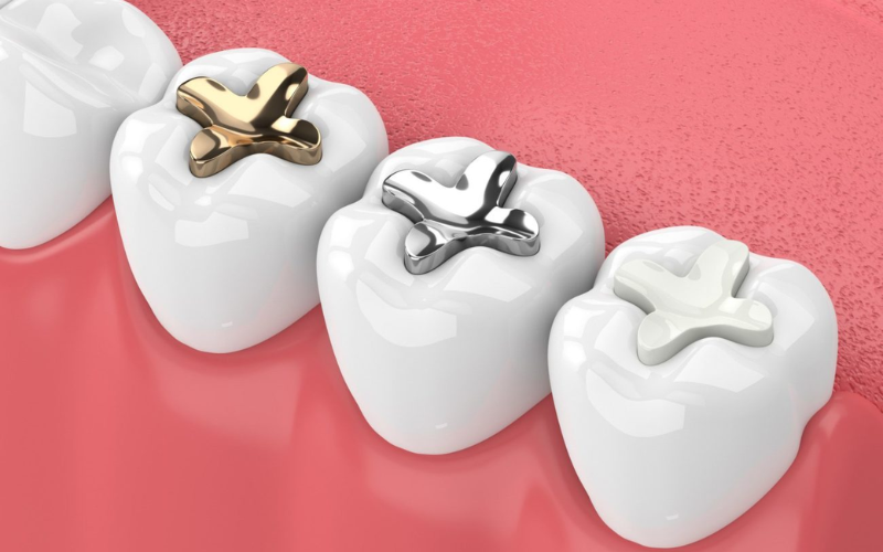 Choose The Right Material for Dental Fillings